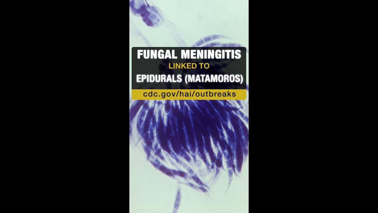 CDC&rsquo;s Tom Chiller on the Outbreak of Fungal Meningitis - V