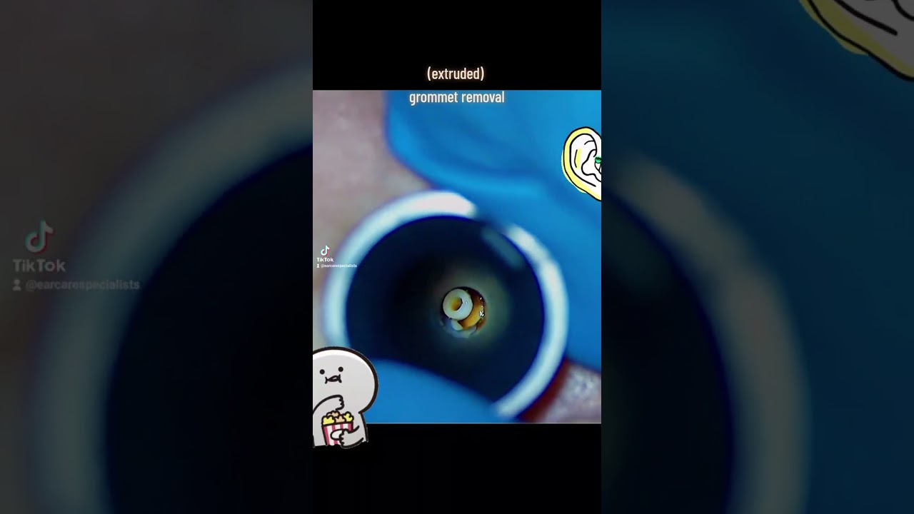 Extruded grommet removal from ear canal #earcarespecialists