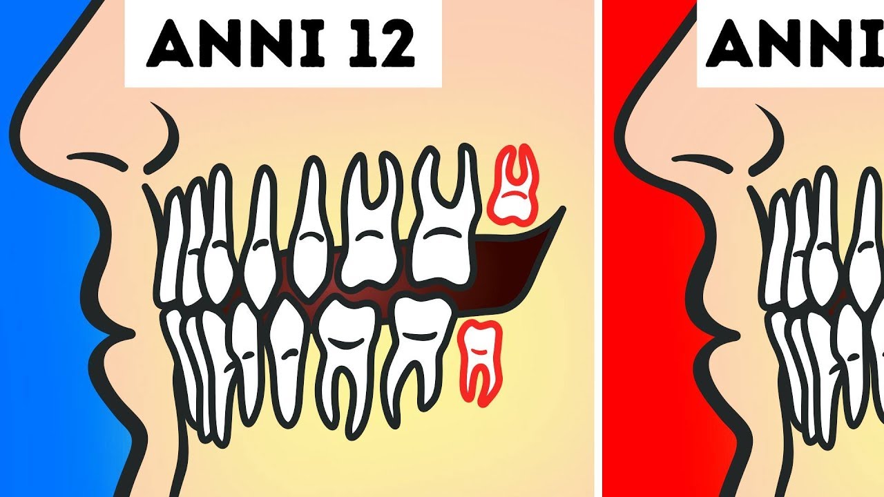 È Davvero Necessario Togliere i Denti Del Giudizio?