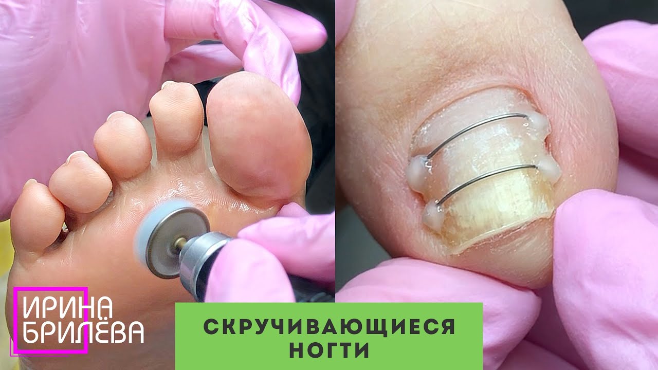 Двойная ТИТАНОВАЯ НИТЬ (NiTi) на скручивающиеся ногти 🌸 ПЕДИКЮР дисками 🌸 Ирина Брилёва