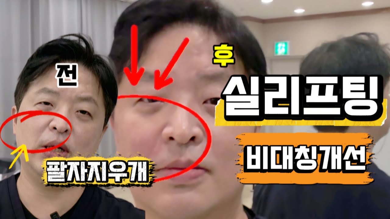 실리프팅 이조합 좋은데? 비대칭맞추려고 한쪽만 시술했습니다