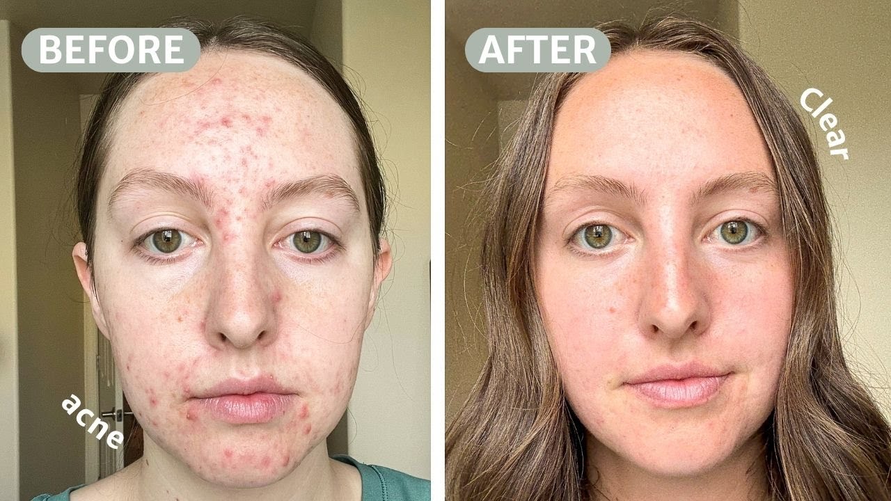 How I finally healed my acne NATURALLY (simple + God-led)