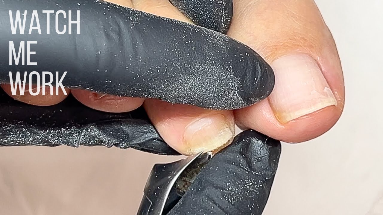 У вас толстые ногти или подногтевой гиперкератоз?