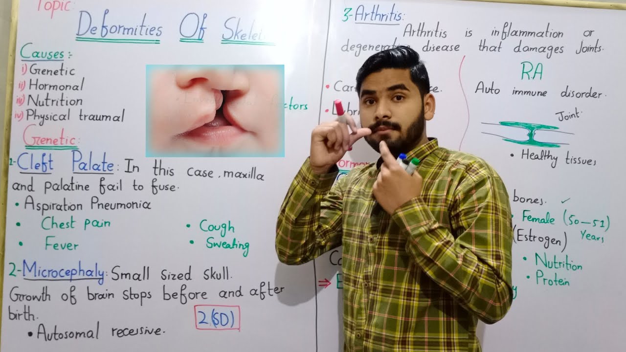Deformities Of Skeleton By Hadi || Cleft Palate, Microcephaly, Osteoporosis Class 12 In Urdu Hindi