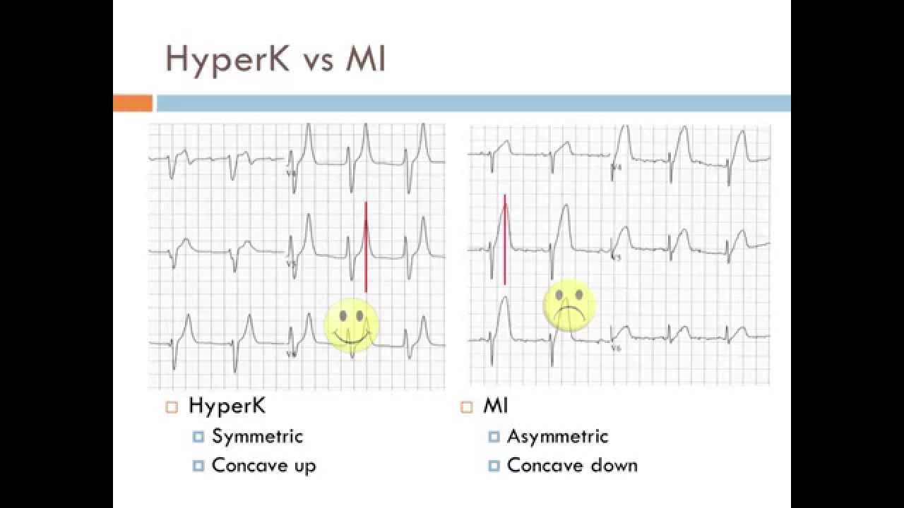 Killer EKGs