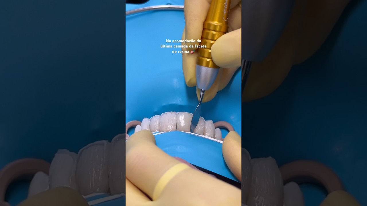 Última camada da faceta ✨ #dentista #dentistas #odontologia #odonto #faceta #facetaderesina