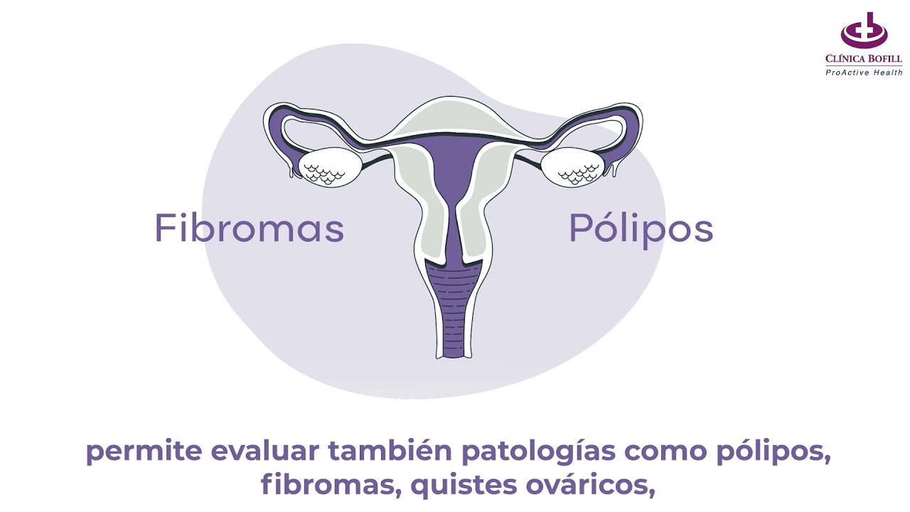 SONOHISTEROSALPINGOGRAFIA (HYFOSY)