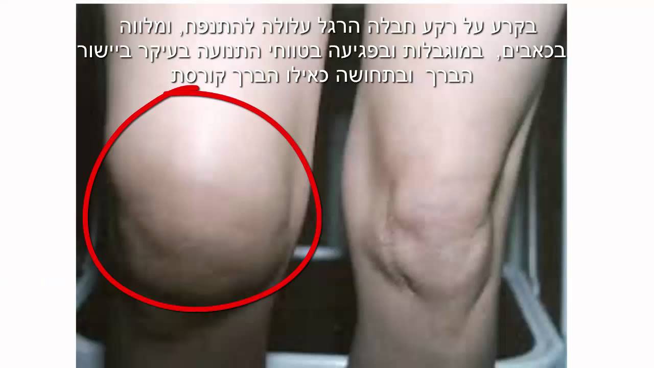 קרע ושחיקת המיניסקוס - כאב פציעות ברכיים - ד