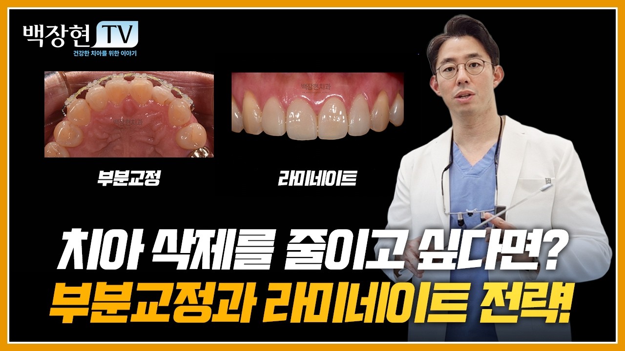 치아 삭제를 줄이고 싶다면? 부분교정과 라미네이트 전략!