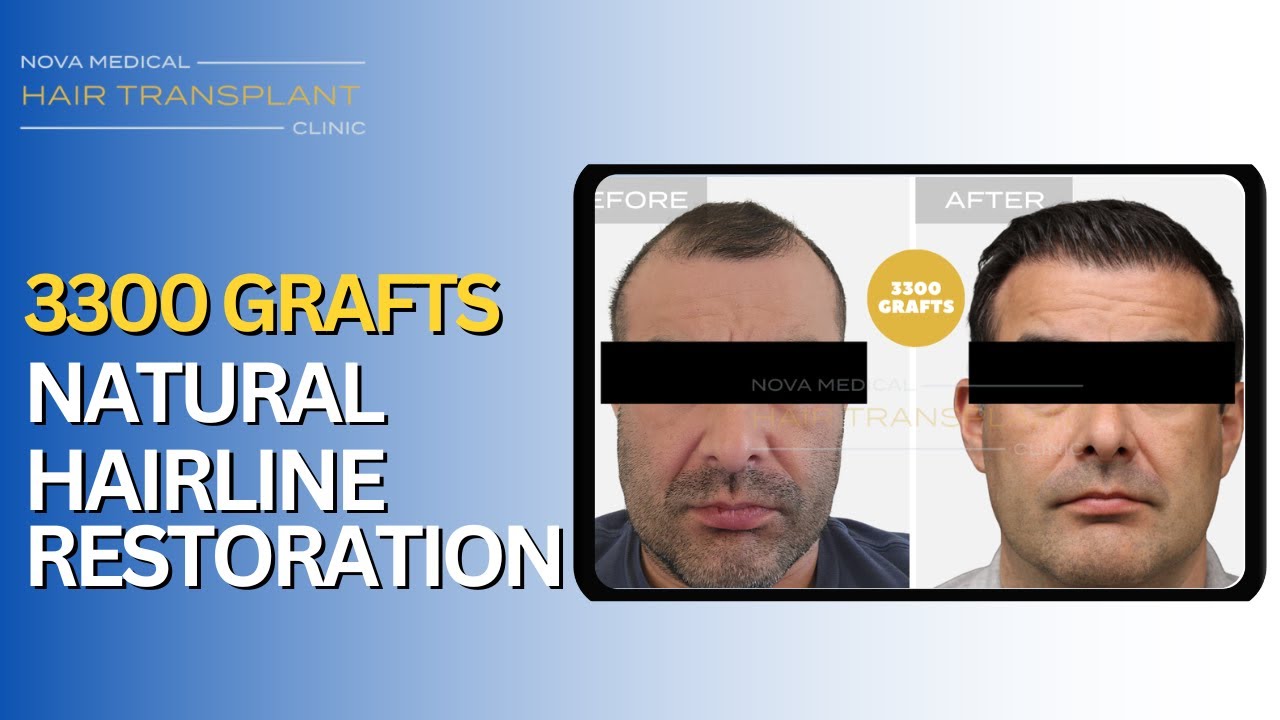 3300 Grafts Hair Transplant | Natural Widow’s Peak & Hairline Restoration