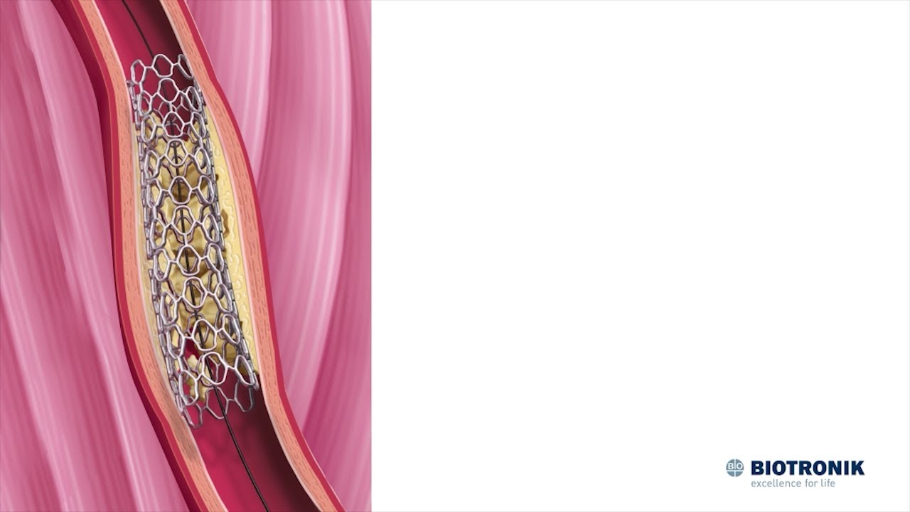 Angioplastica e stenting | Animazione medica