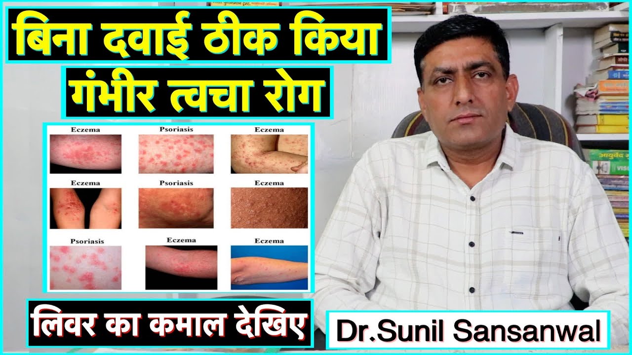 वैद्य ने त्वचा रोग बिना दवाई ठीक कर दिया, लिवर का कमाल देखिए || Technical Farming ||