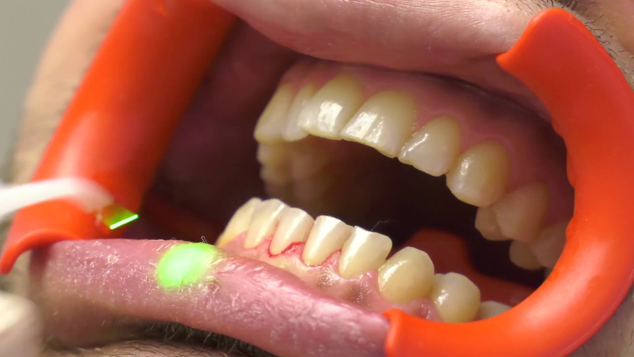 Finest Professional Tooth Cleaning with different Laser Systems