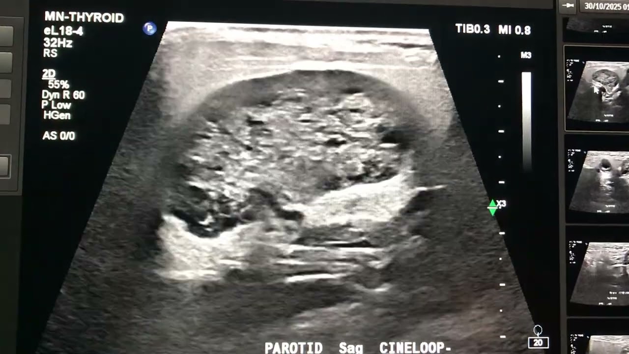 interesting case 60.  - schwannoma -Ultrasound