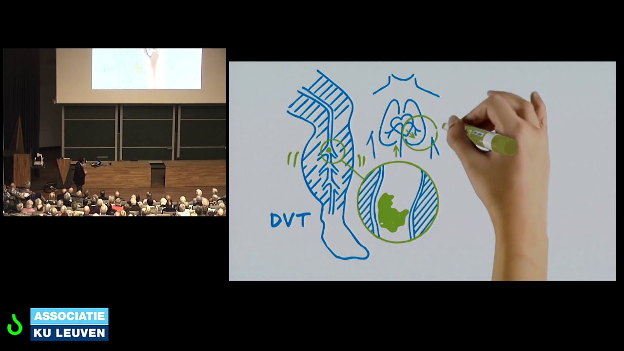 Hoorcollege  Prof. Peter Verhamme - UZ Leuven - deel 3   longembolie