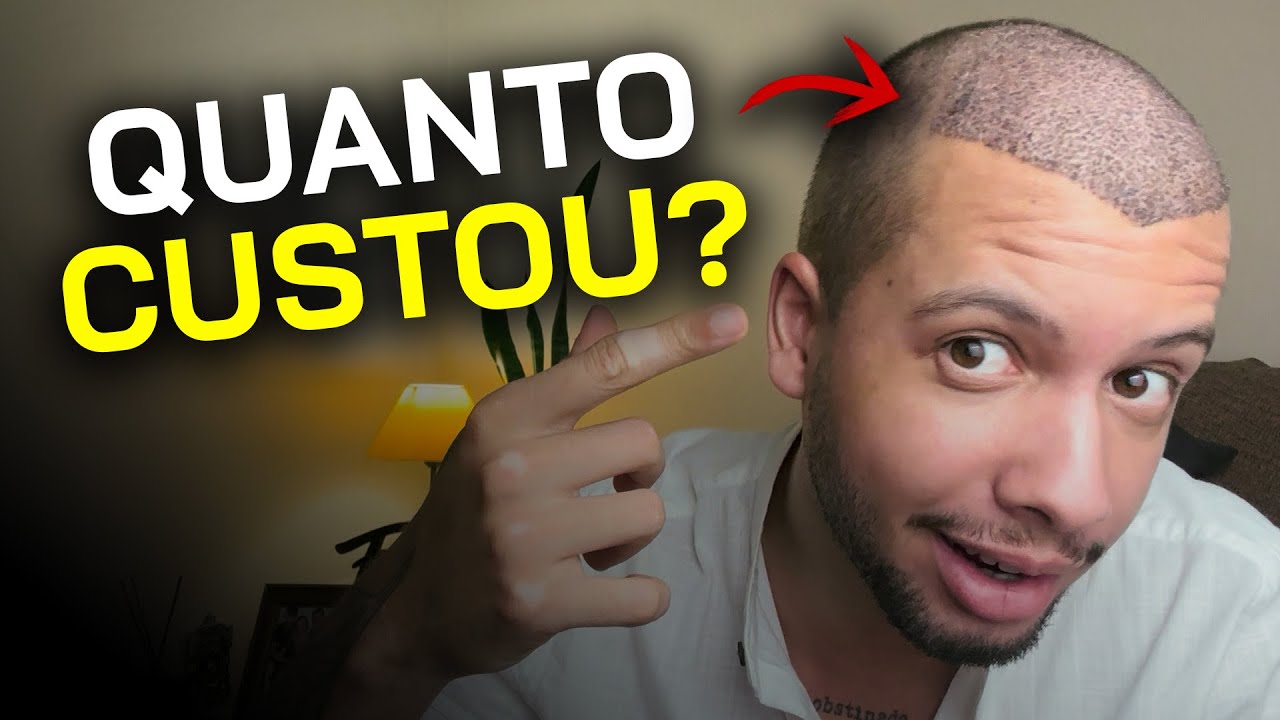 QUANTO CUSTOU MEU TRANSPLANTE CAPILAR EM 2025? RESPONDENDO DÚVIDAS