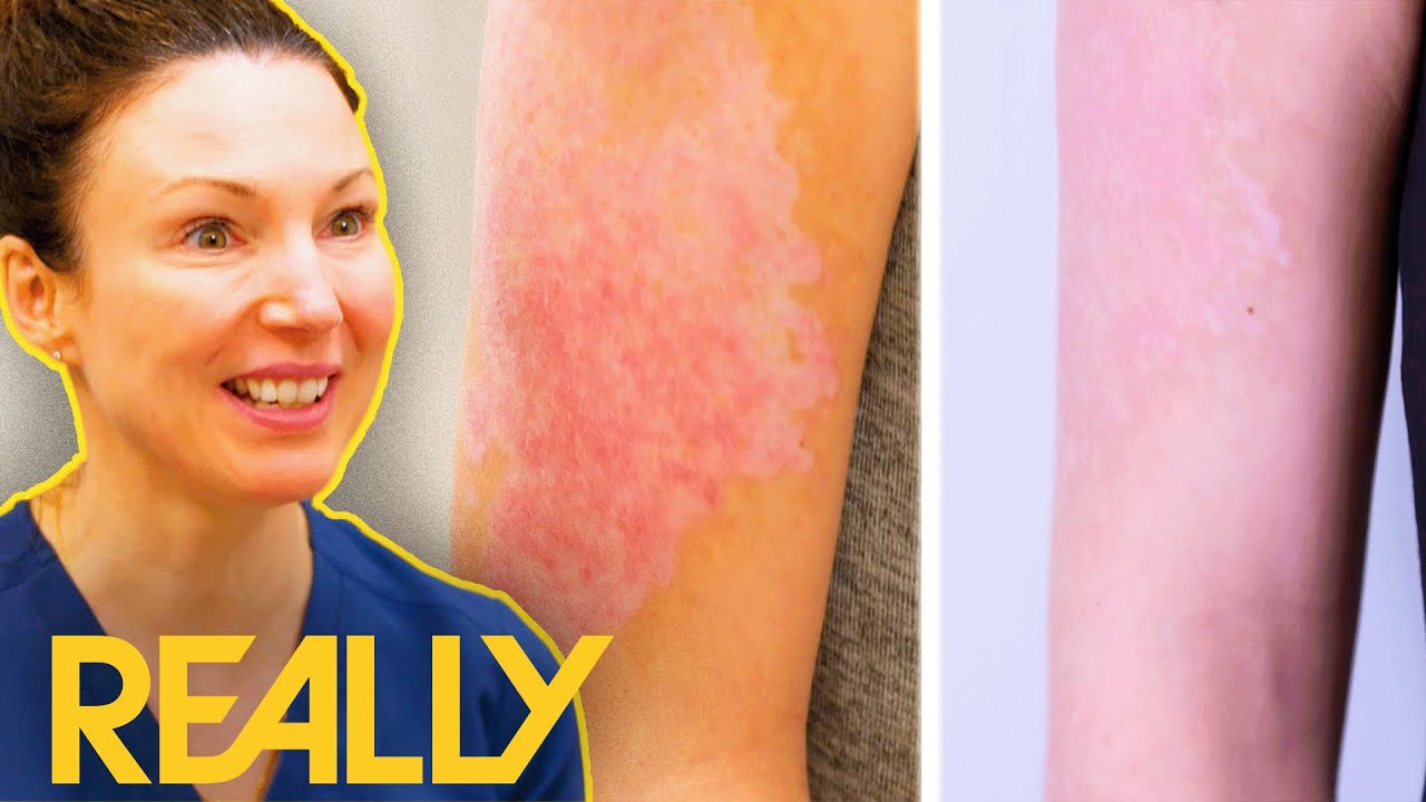 “It Feels Like Boiling Water” Mum Struggles With Lupus | The Bad Skin Clinic