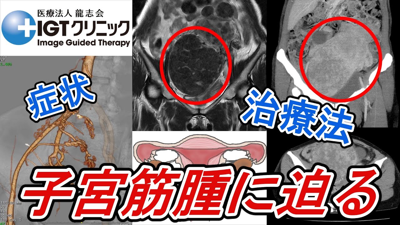 【子宮筋腫とは？PART１】～子宮筋腫に迫る～