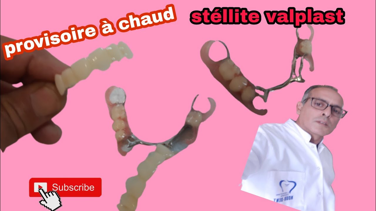 bridge provisoire à chaud. Méthode mise en moufle. stéllite métallique valplast.