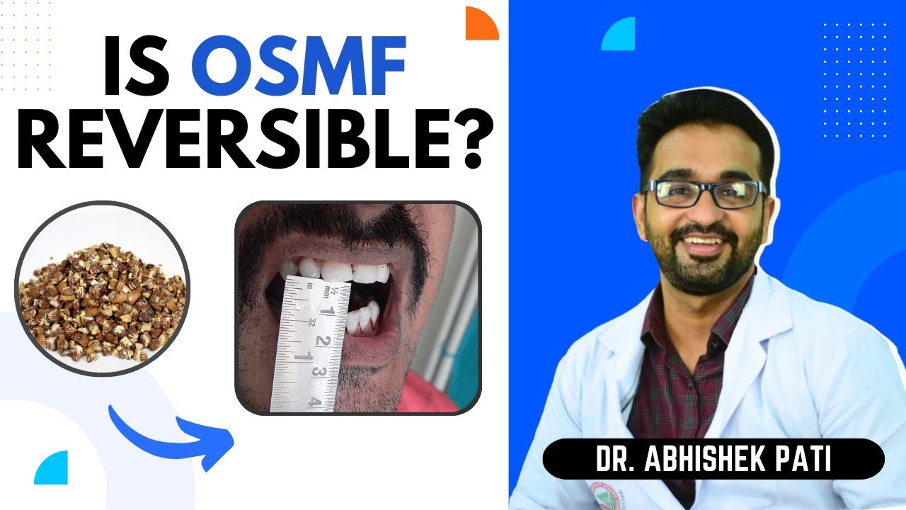 IS OSMF REVERSIBLE?