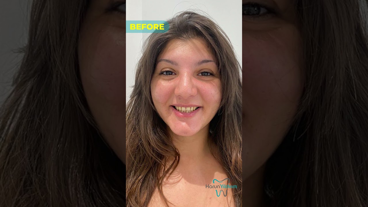 Unforgettable Summer Smiles with Dentist Harun Yildirim