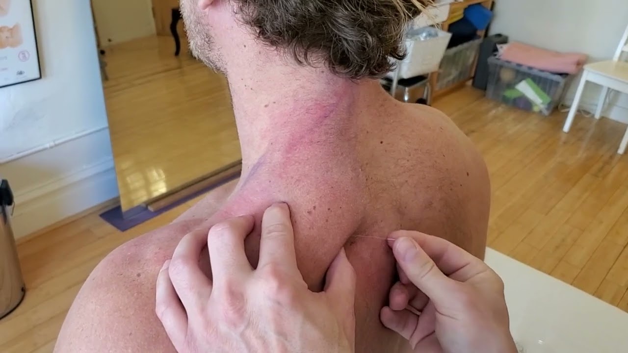Dry Needling of Levator Scapulae Trigger Points (with Auto-Dubbing in Multiple Languages)