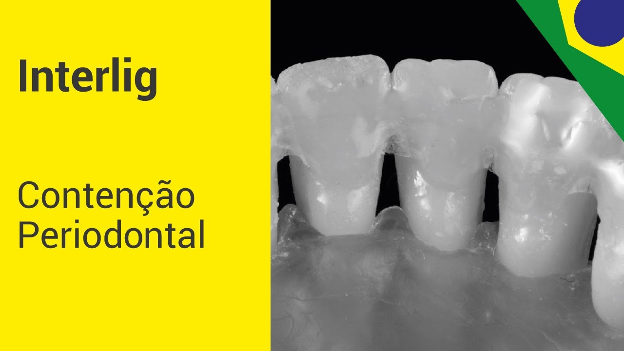 Interlig | Contenção Periodontal