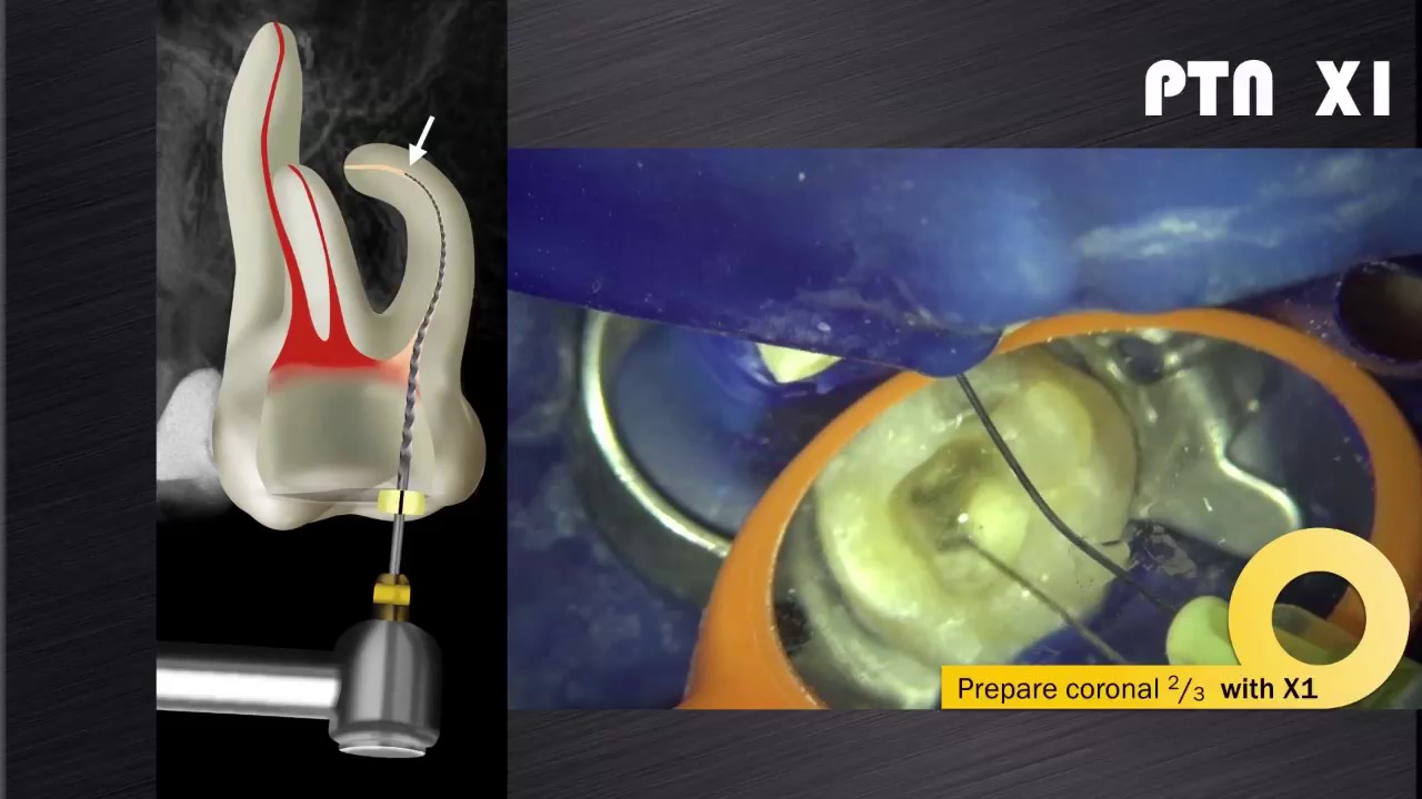 ProTaper Next™ - Shaping tips – Dr. Peet van Der Vyver | Denstply Sirona