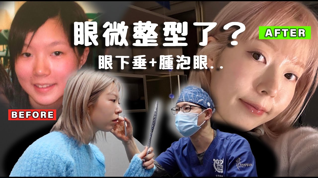 偷偷去割雙眼皮了?!!眼型變化全公開⋯鬆弛浮腫+像未睡飽很困擾！為什麼我樣子變化這麼大！醫生竟然說(嚇)⋯