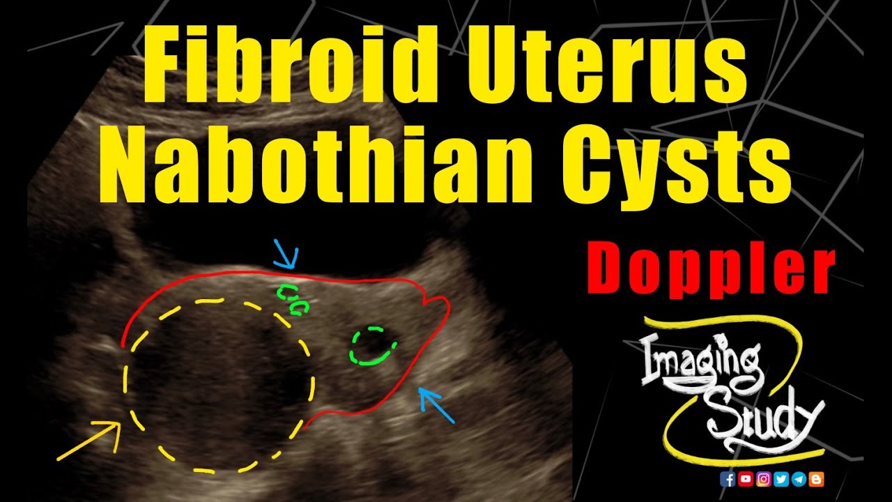 Fibroid Uterus with Nabothian Cysts || Ultrasound || Doppler || Case 267