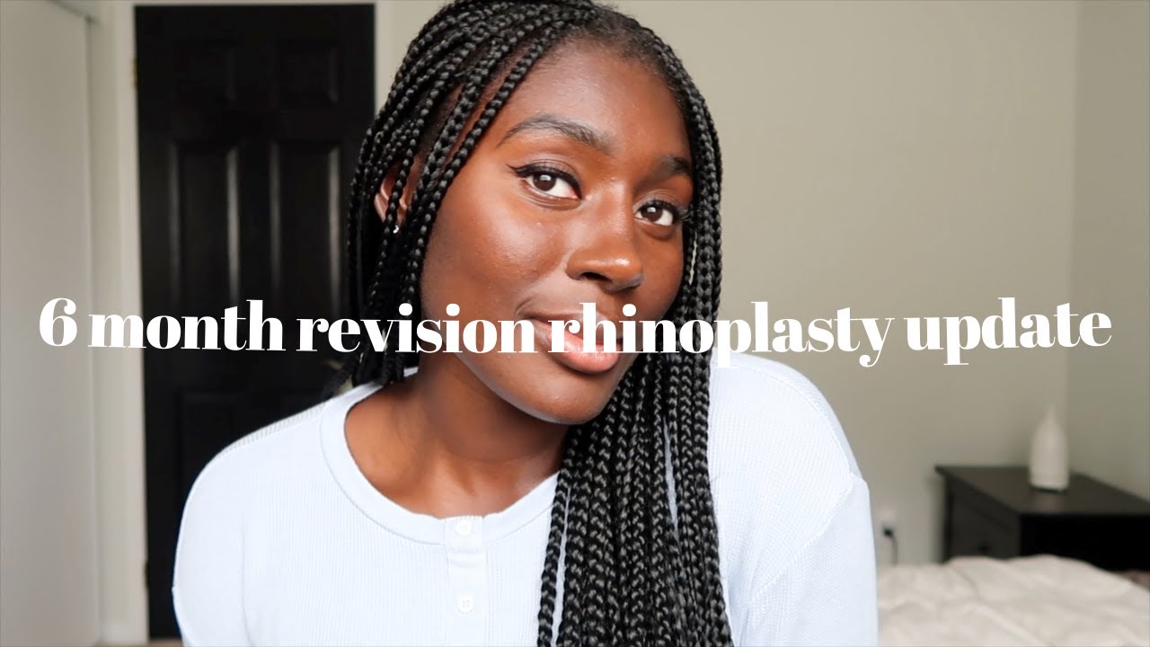 6 month revision rhinoplasty update | DR.EMRAH CELIK