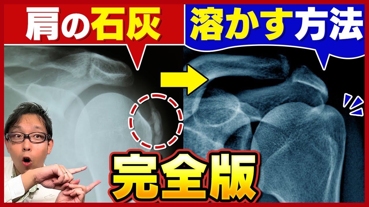 【全解説】石灰を溶かす方法 / 肩石灰沈着性腱板炎の治療法大全