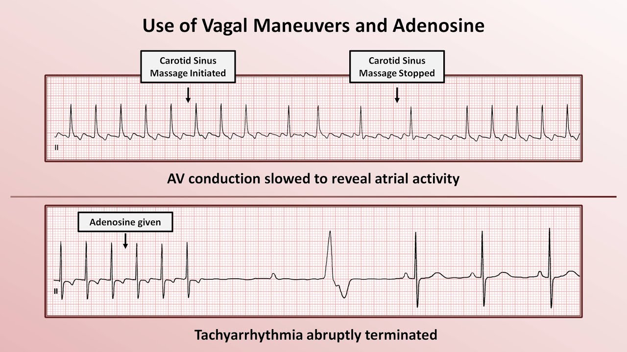 Intro to EKG Interpretation - How to Identify Any Tachyarrhythmia with 6 Easy Questions