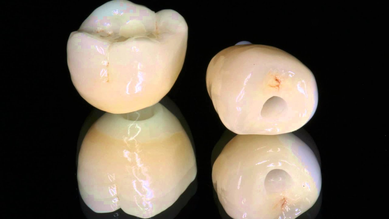 Straumann variobase implant prosthesis in posterior maxilla , hama