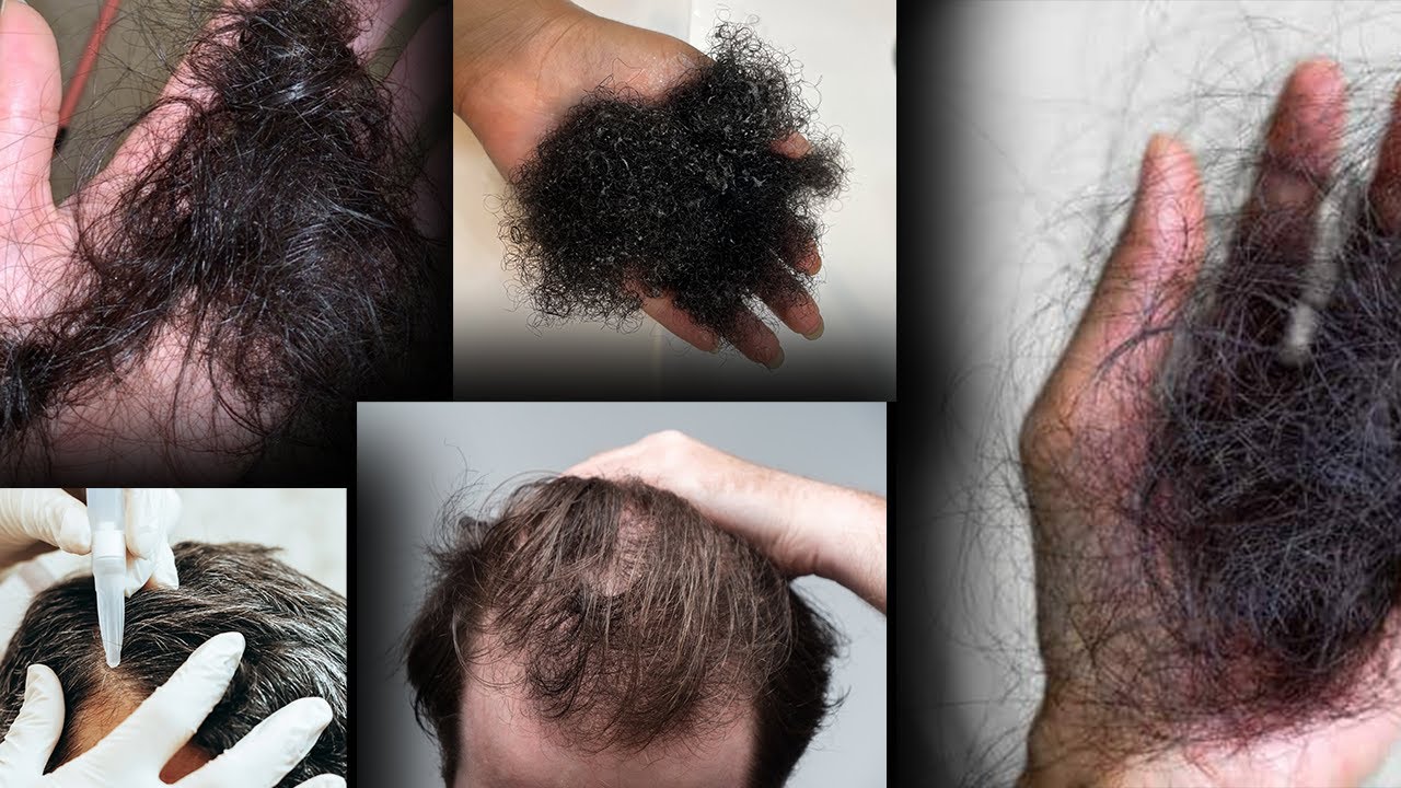 Finasteride & Dutasteride Shedding Explained (NO Bullsh*t!)