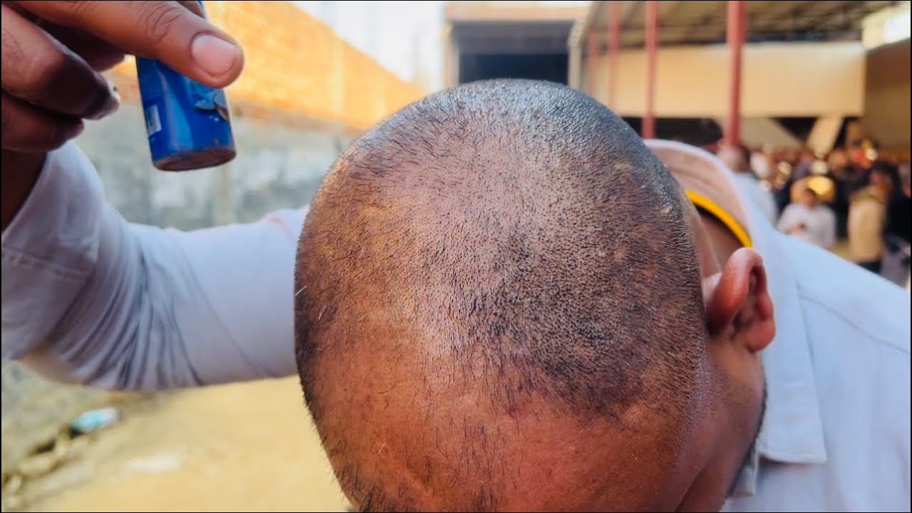 सलमान की चमत्कारी बालों की दवाई मंडोली चुंगी 🔥!! Alopecia Areata Hair Loss Problam Solve !! Hair Los