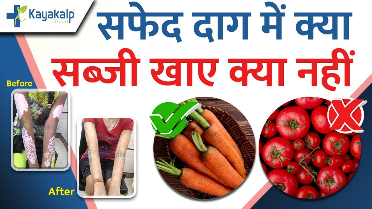 ✅सफेद दाग में क्या सब्जी खाए क्या नहीं? | Preventing Vitiligo with Diet & Home Remedies | Kayakalp