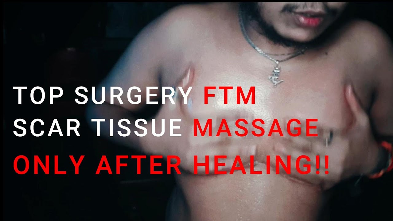 TOP SURGERY SCAR MASSAGE |TRANSMAN VLOG | FTM | FEMALE TO MALE | INDIA