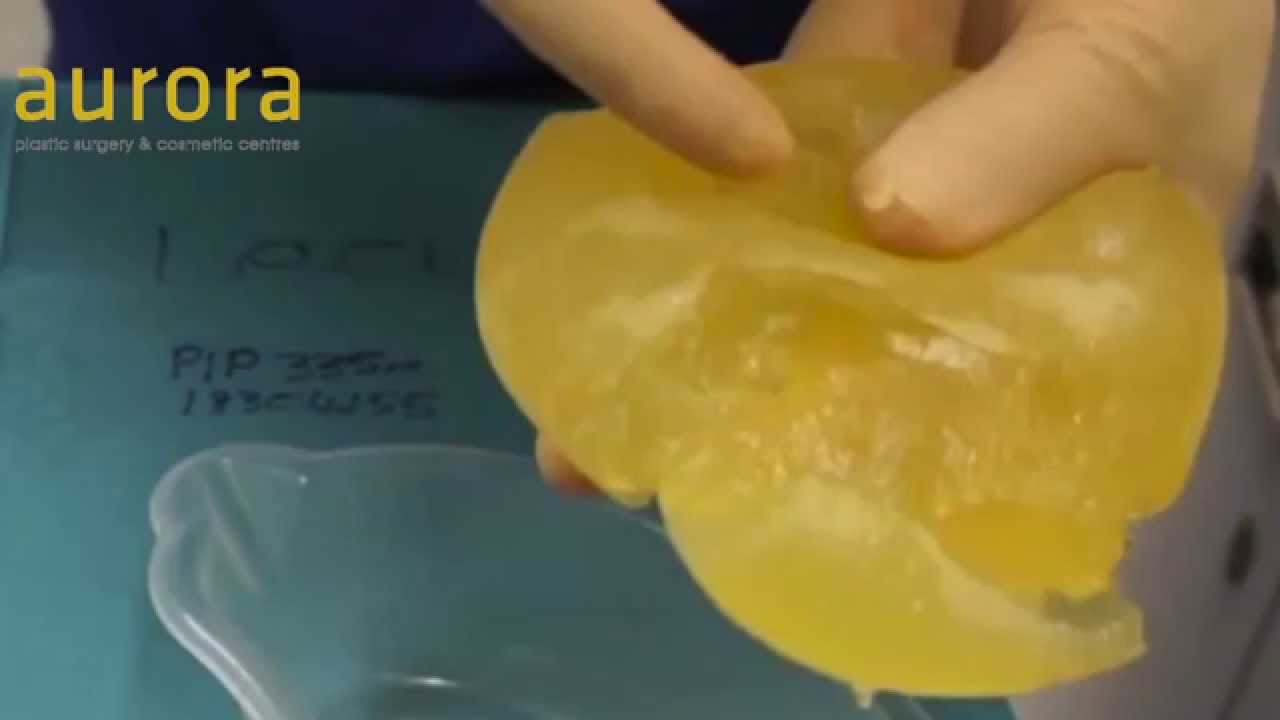 PIP Implants - How can you tell if your PIP implants are ruptured?