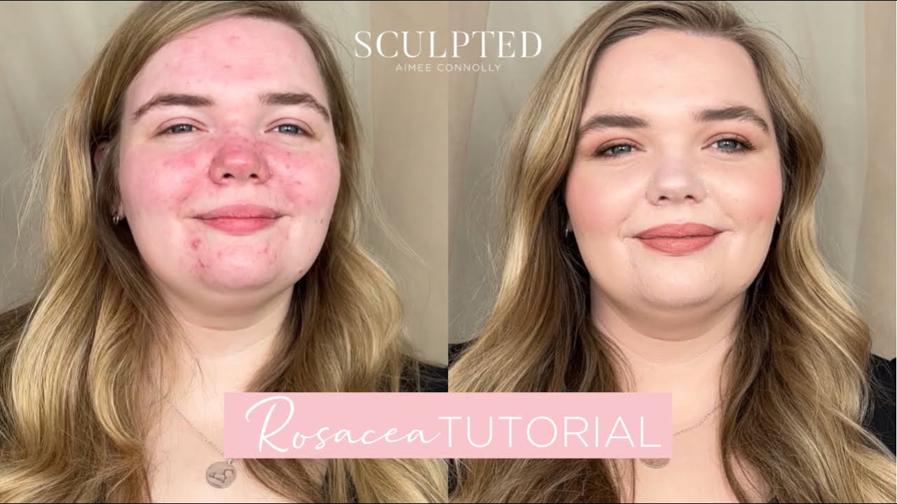ROSACEA TUTORIAL | how to conceal rosacea