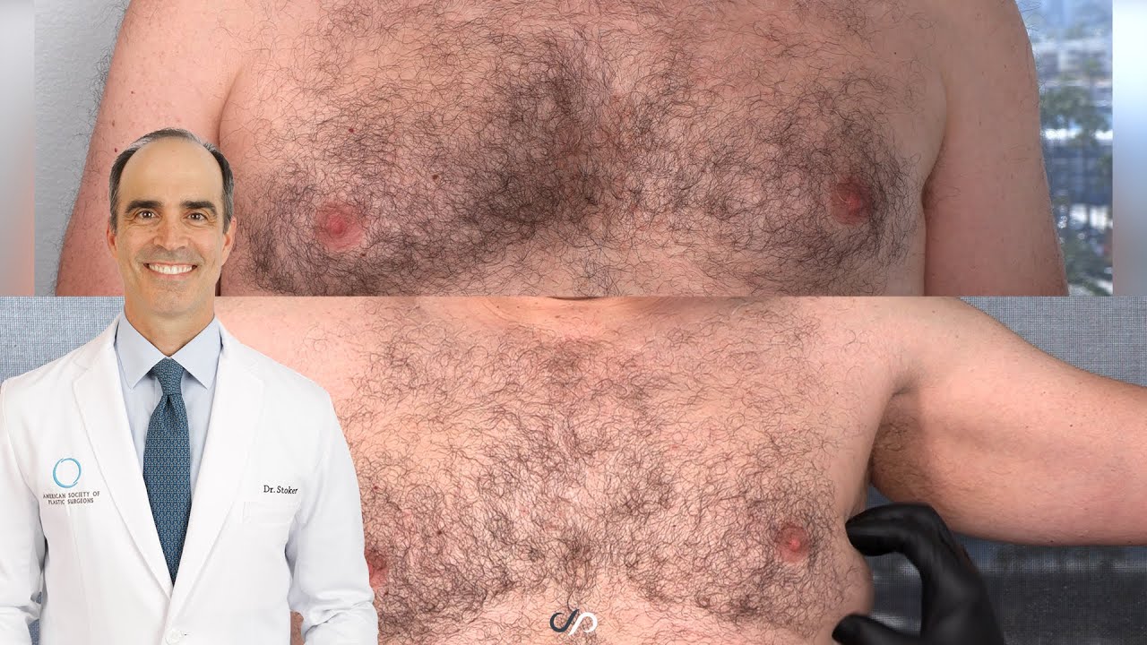 Male Chest Contouring | Gynecomastia Before and After | Dr. David Stoker