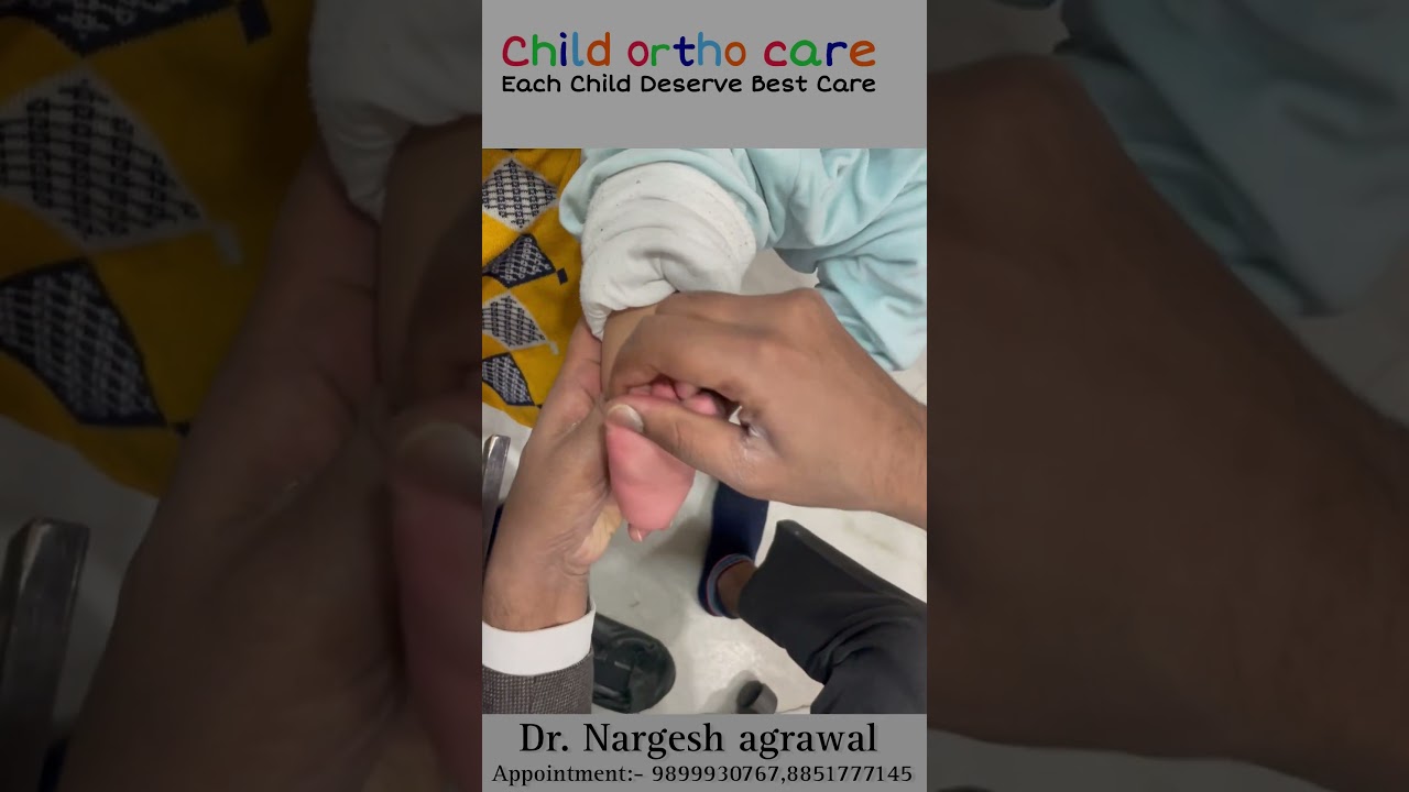 Clubfoot both feet fully corrected with plasters @childorthocare #clubfoottreatment #ctev