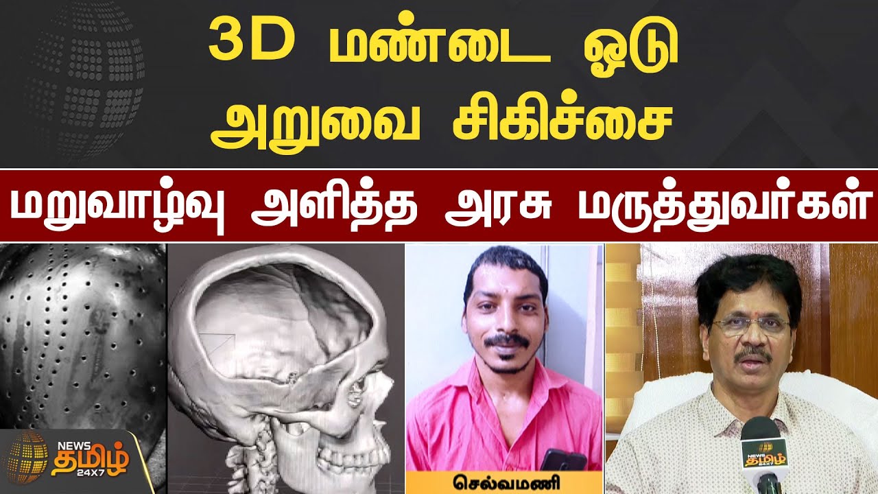 3D மண்டை ஓடு அறுவை சிகிச்சை... மறுவாழ்வு அளித்த அரசு மருத்துவர்கள் | Chennai | 3D Operation