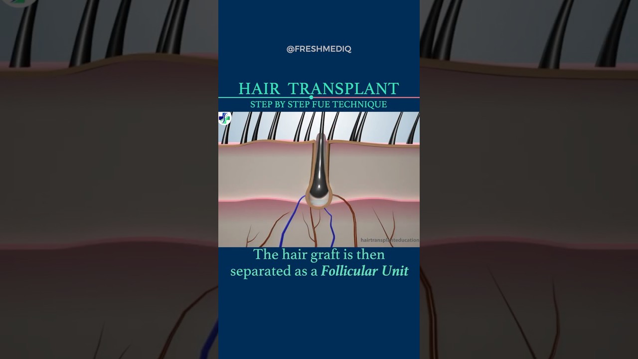 How FUE Hair Transplant Works