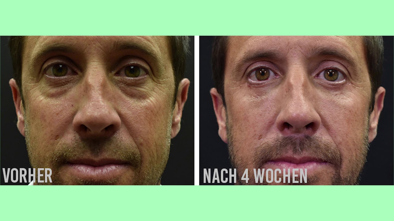 Müde Augen & Augenringe loswerden. Was mir endlich geholfen hat!