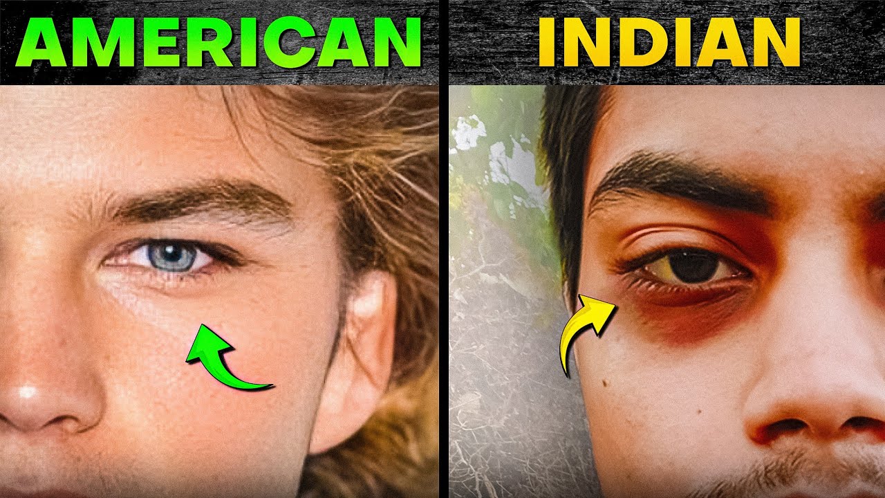 How Your Indian Genes Give You Dark Circles (And How to Fix Them)