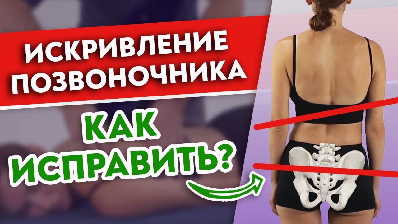 Как исправить искривление позвоночника и перекос таза?