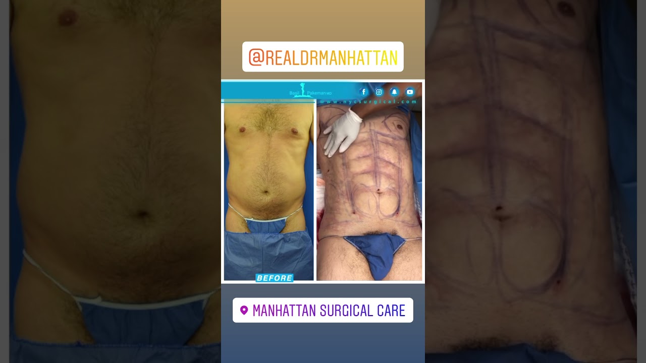 Abdominal Etching Male