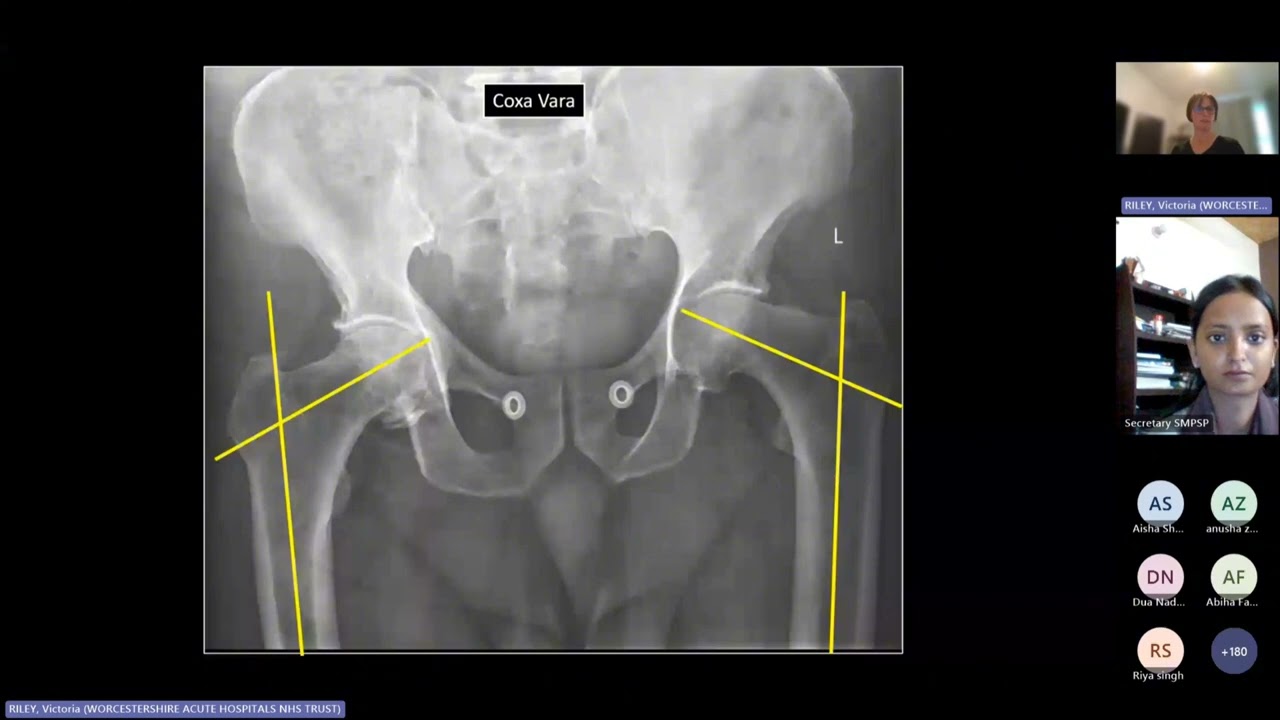 Interpreting X-Rays of Osteoarthritis and Impingement in the Hip: Webinar 05