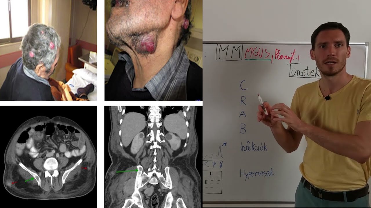 Myeloma Multiplex 1/2 - miért alakul ki? Milyen tüneteket okozhat?